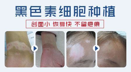 头皮白癜风症状
